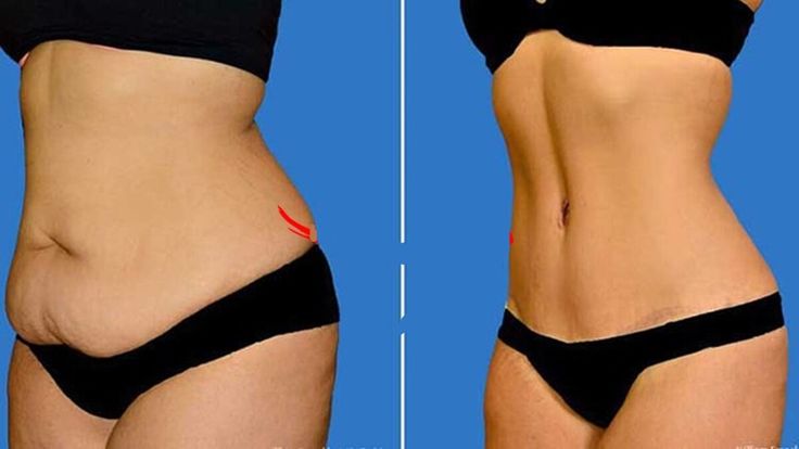 Firmer Abdomen with Tummy Tuck Surgery in Delhi